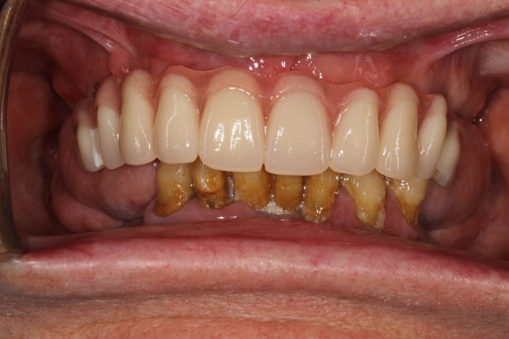 Implant Retained Dentures | Permanent Dentures | Boyne Dental
