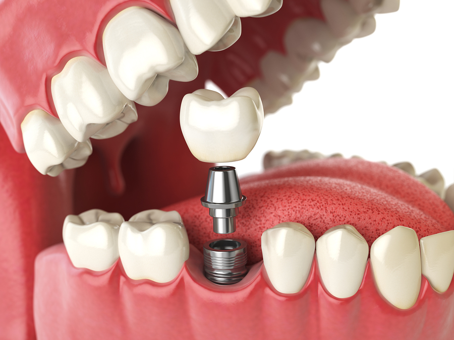 Tooth human implant. Dental concept. Human teeth or dentures. 3d